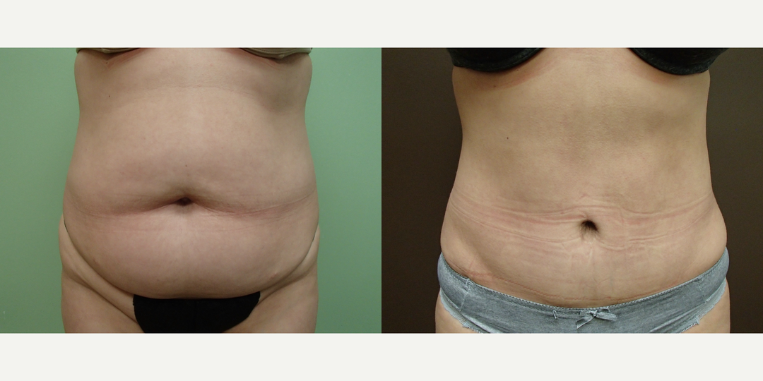 Mommy Makeover procedure image