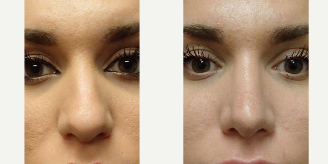Rhinoplasty (Nose Job) procedure image