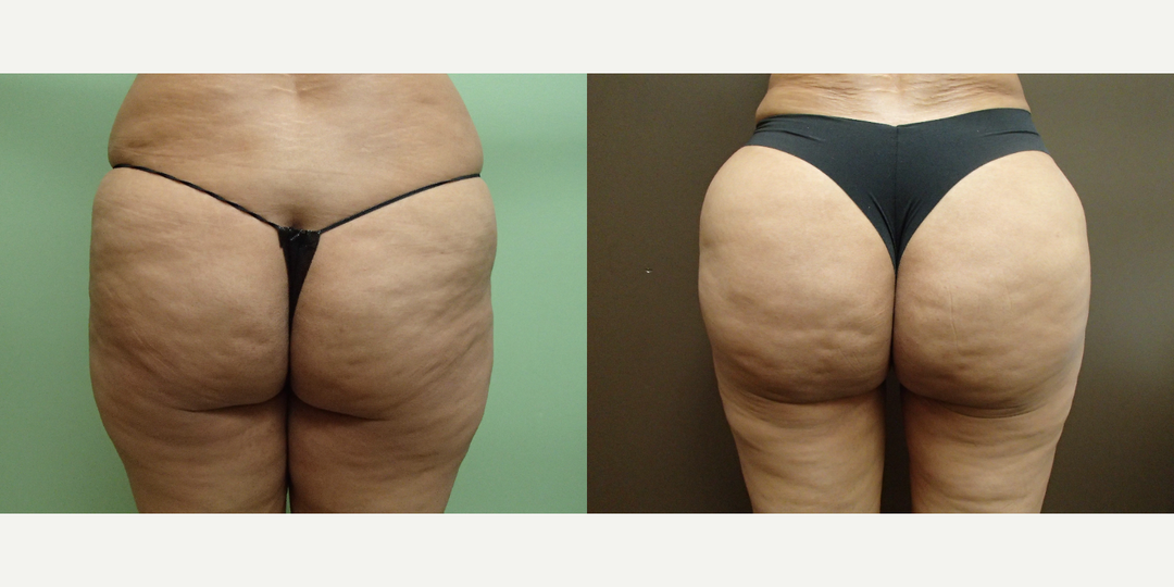 Brazilian Butt Lift (BBL) procedure image