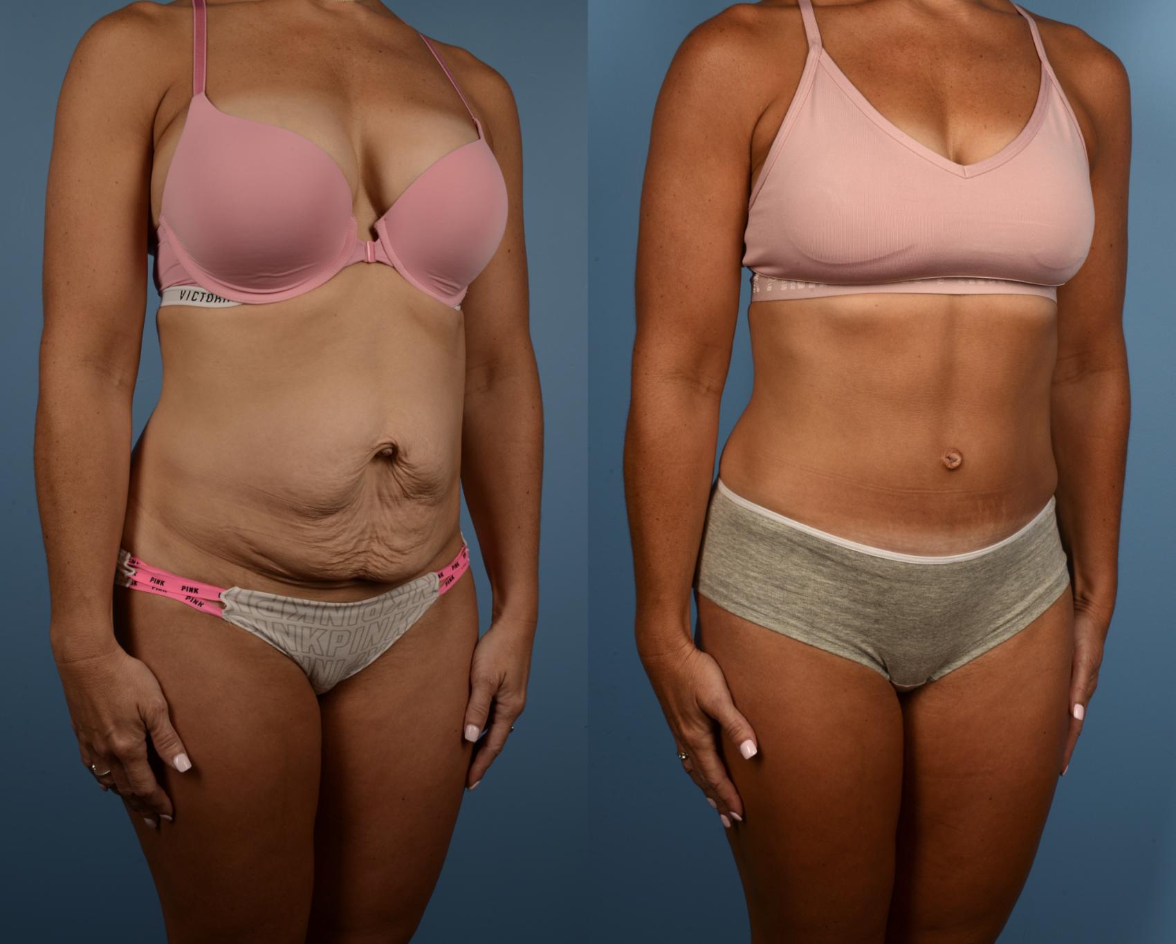 Tummy Tuck (Abdominoplasty) procedure image
