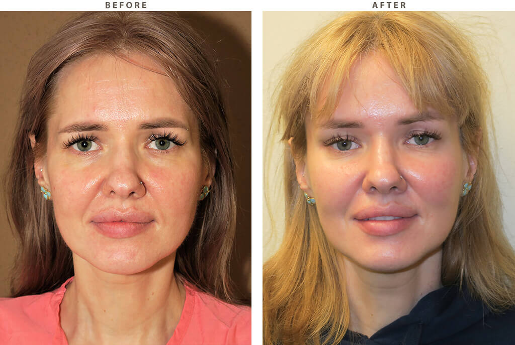 Facelift procedure image
