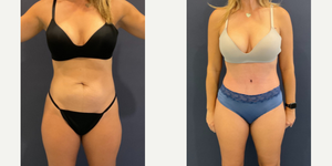 Liposuction procedure image
