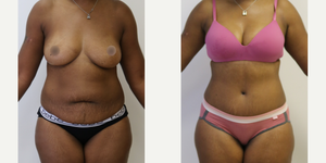 Mommy Makeover procedure image