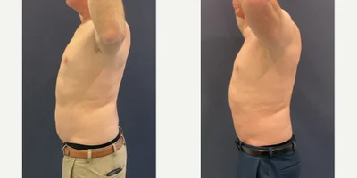 Skin Tightening procedure image