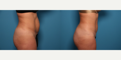 Liposuction procedure image