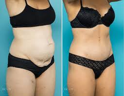 Mommy Makeover procedure image