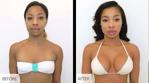 Breast Augmentation procedure image