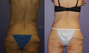 Liposuction procedure image