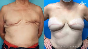 Breast Augmentation procedure image