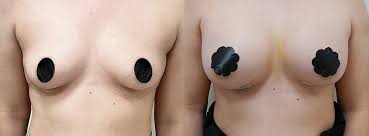 Breast Augmentation with Lift procedure image