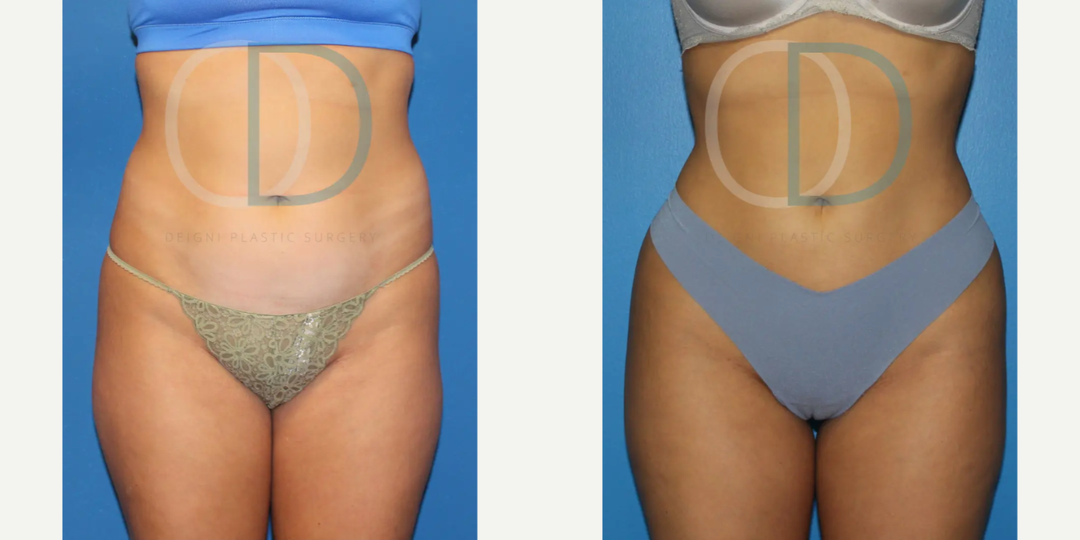 Tummy Tuck (Abdominoplasty) procedure image