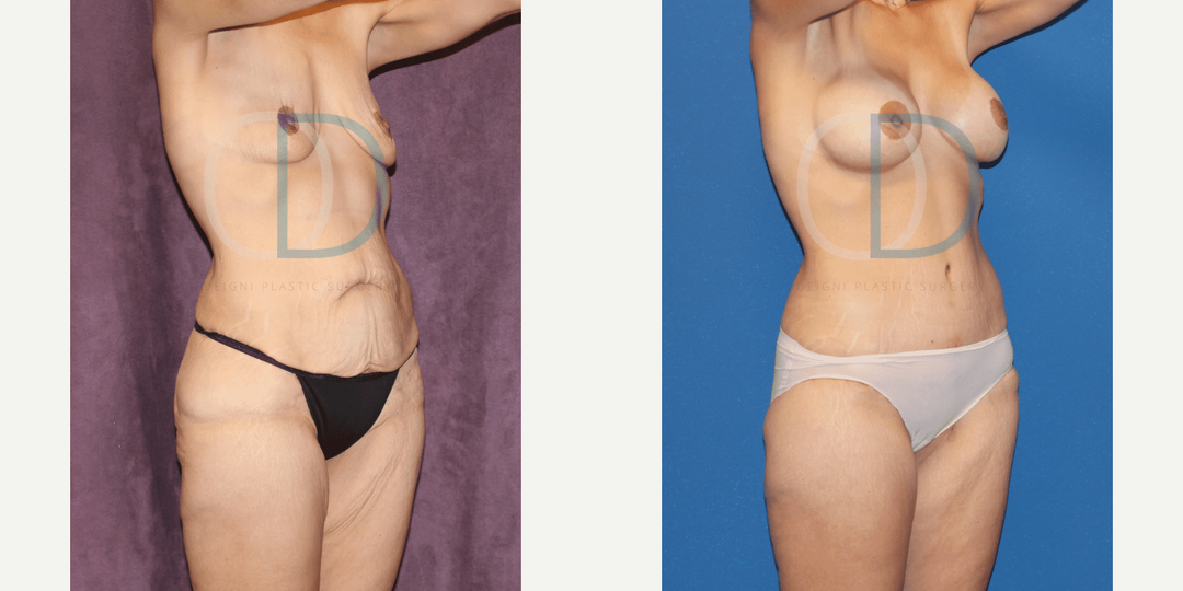 Mommy Makeover procedure image