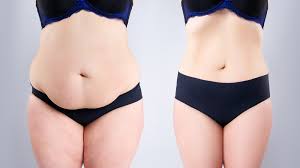 Tummy Tuck (Abdominoplasty) procedure image