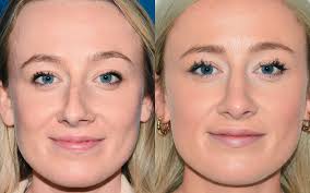 Rhinoplasty (Nose Job) procedure image