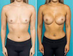 Breast Augmentation procedure image