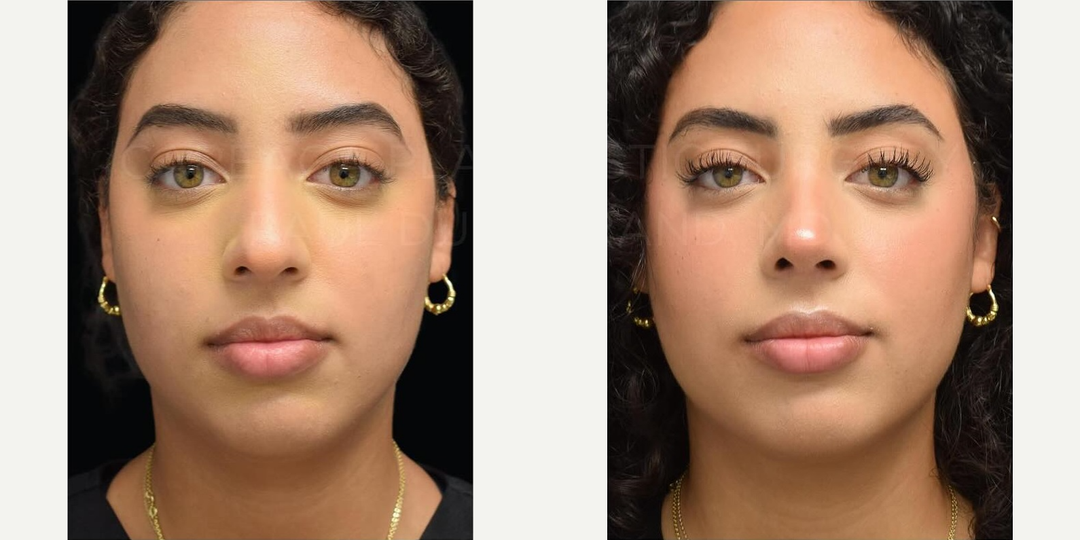 Rhinoplasty (Nose Job) procedure image