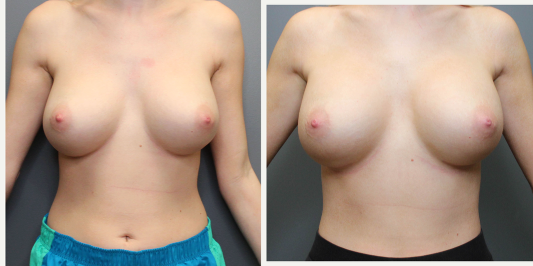 Mommy Makeover procedure image