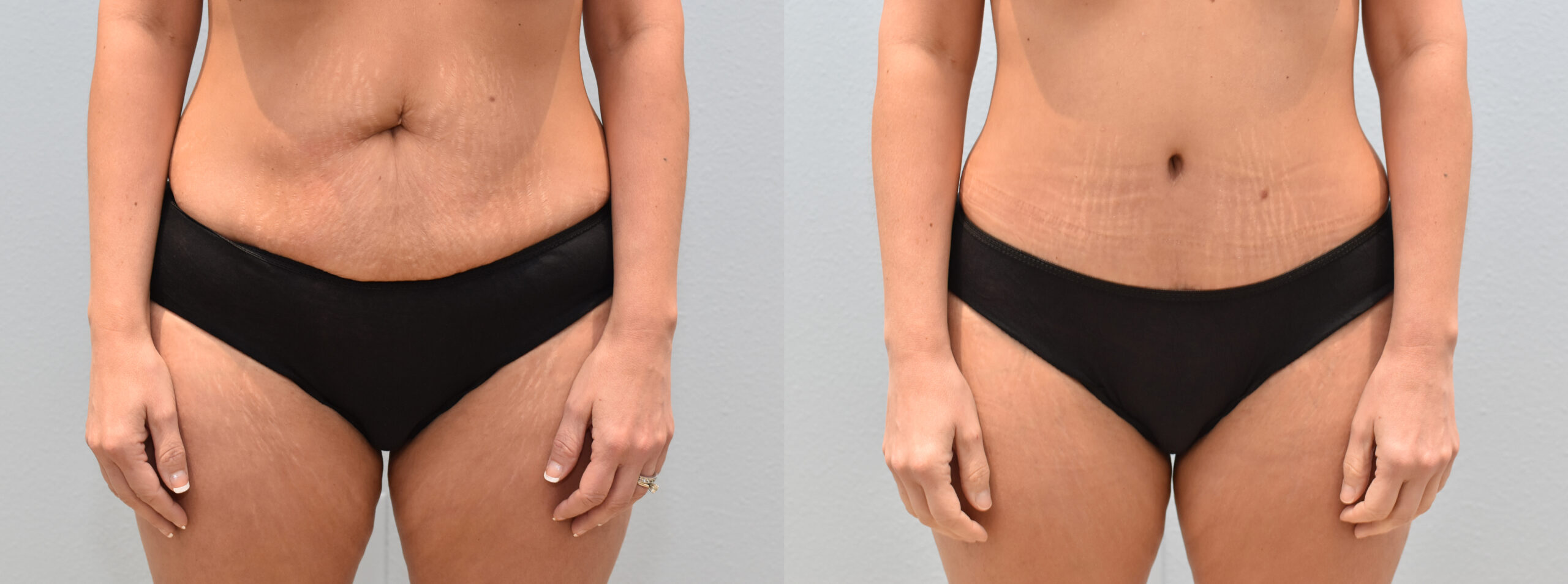 Tummy Tuck (Abdominoplasty) procedure image
