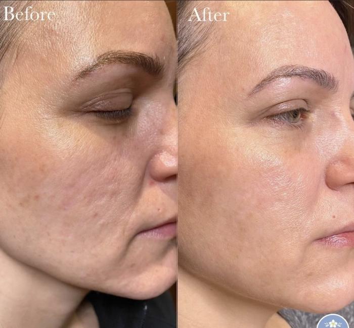 Skin Tightening procedure image