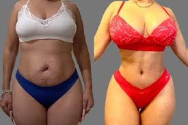 Mommy Makeover procedure image