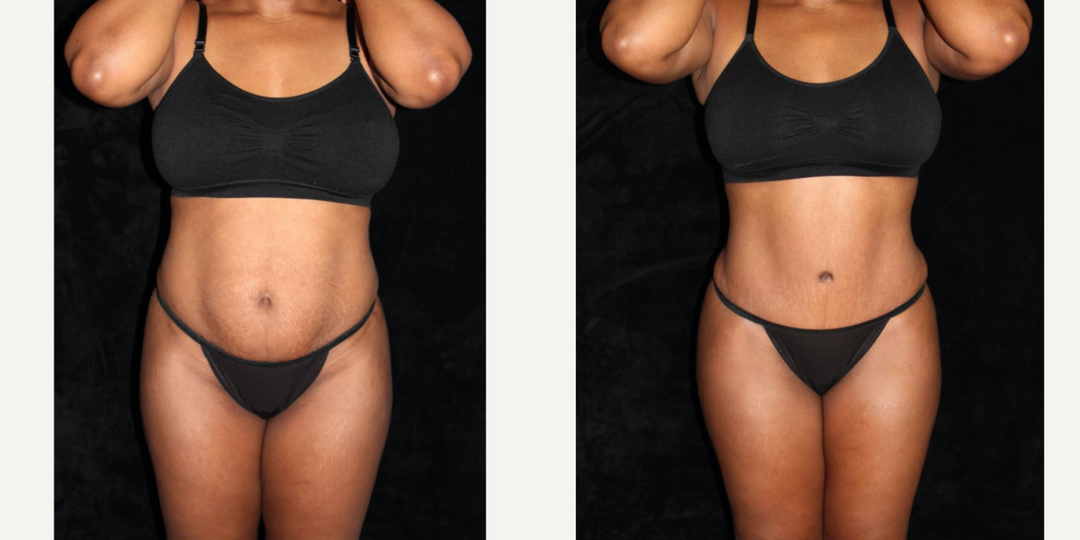 Tummy Tuck (Abdominoplasty) procedure image