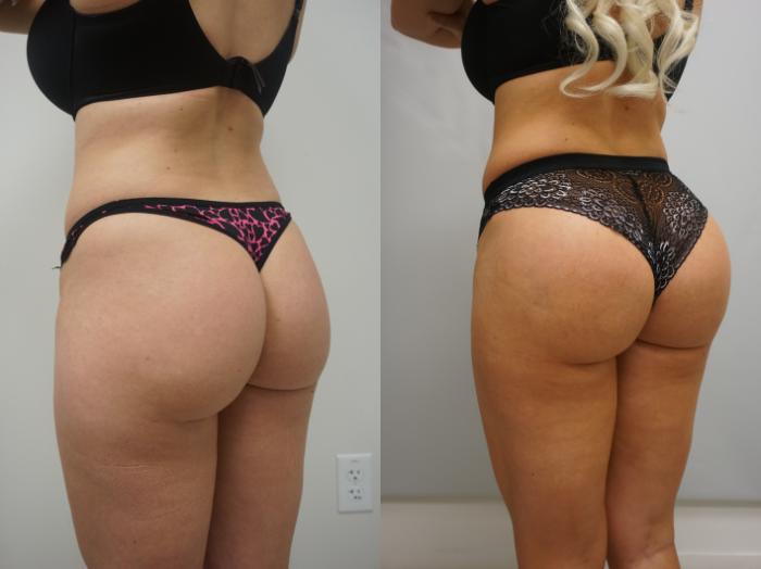 Brazilian Butt Lift (BBL) procedure image