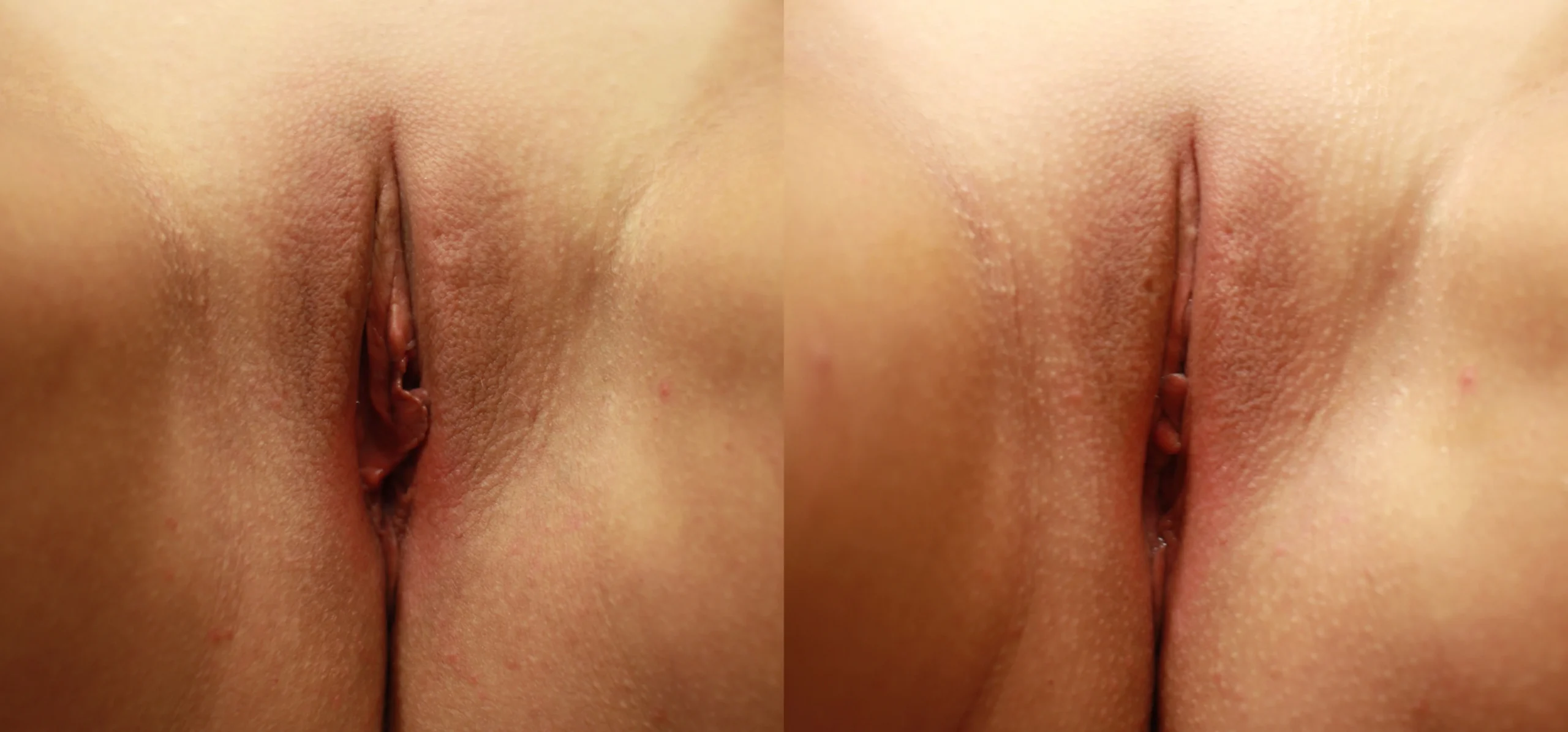 Vaginal Rejuvenation procedure image