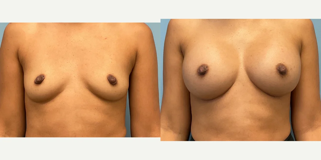 Breast Implants (Saline/Silicone) procedure image