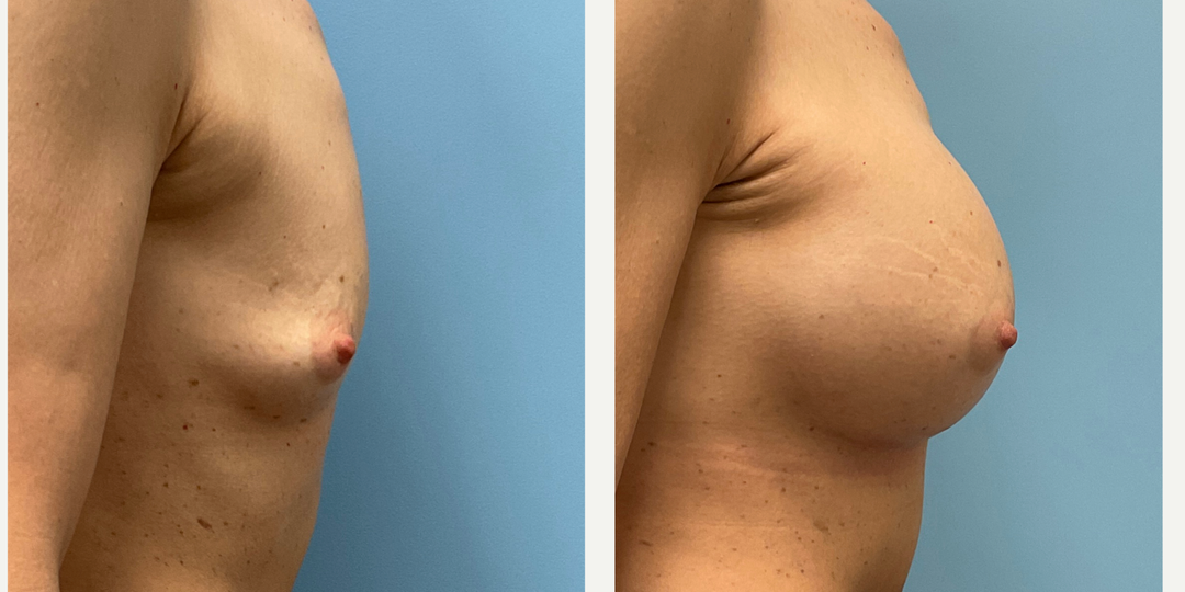 Breast Augmentation procedure image