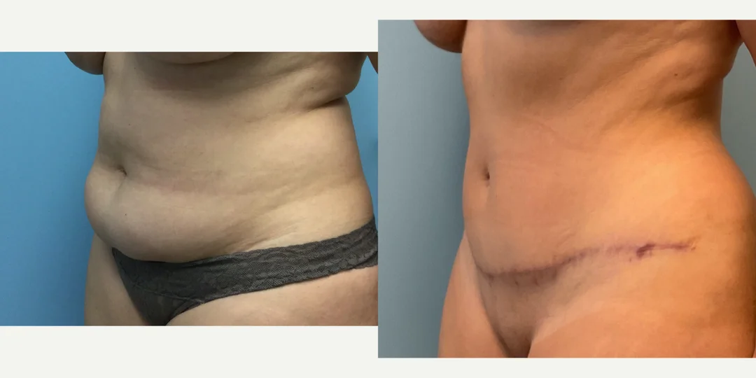 Skin Tightening procedure image