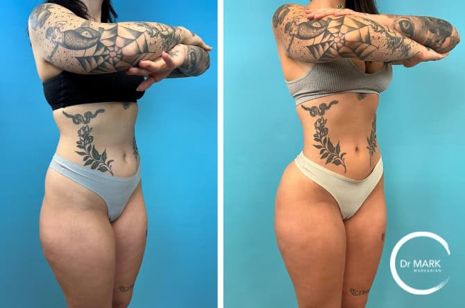 Lipo 360 procedure image