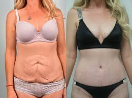 Tummy Tuck (Abdominoplasty) procedure image