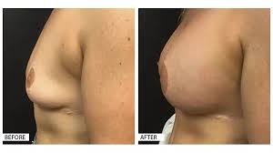 Breast Augmentation procedure image