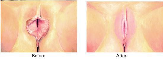 Vaginal Rejuvenation procedure image