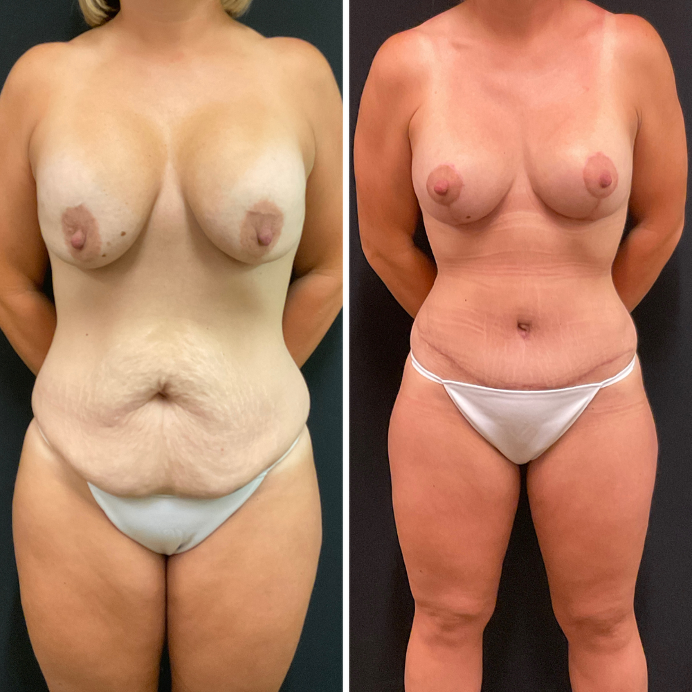 Mommy Makeover procedure image