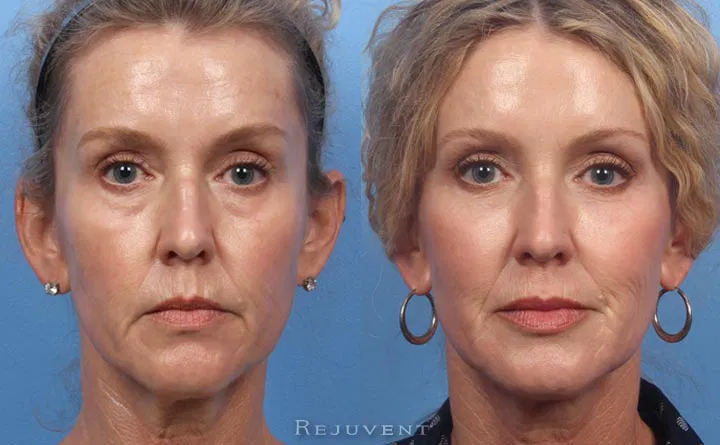 Cheek Enhancement procedure image