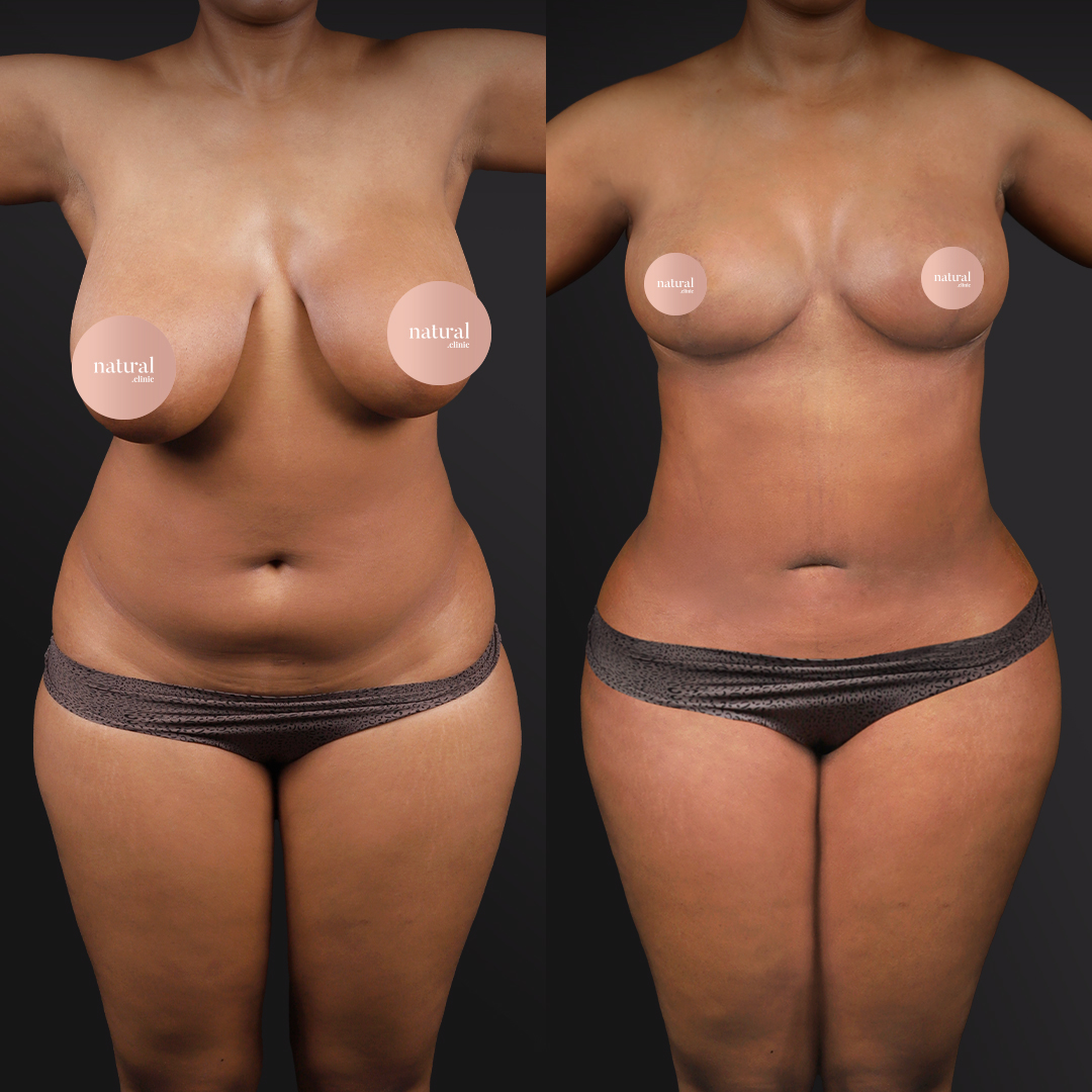 Mommy Makeover procedure image