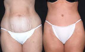 Tummy Tuck (Abdominoplasty) procedure image
