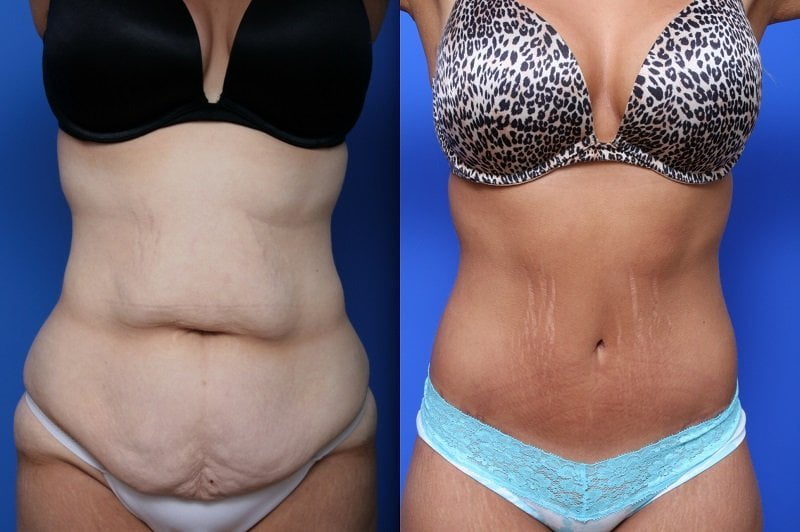 Mommy Makeover procedure image