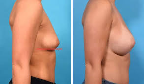 Breast Augmentation procedure image