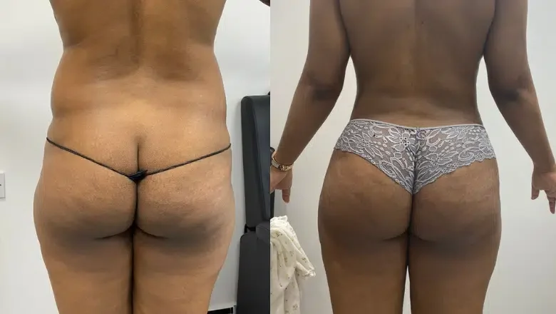 Brazilian Butt Lift (BBL) procedure image