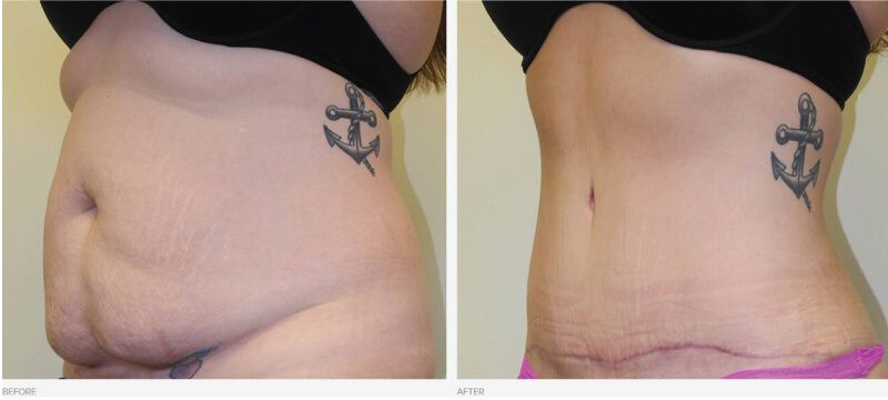 Tummy Tuck (Abdominoplasty) procedure image