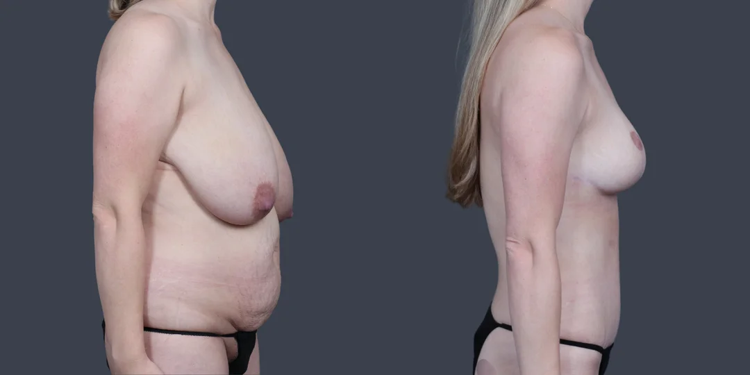 Liposuction procedure image