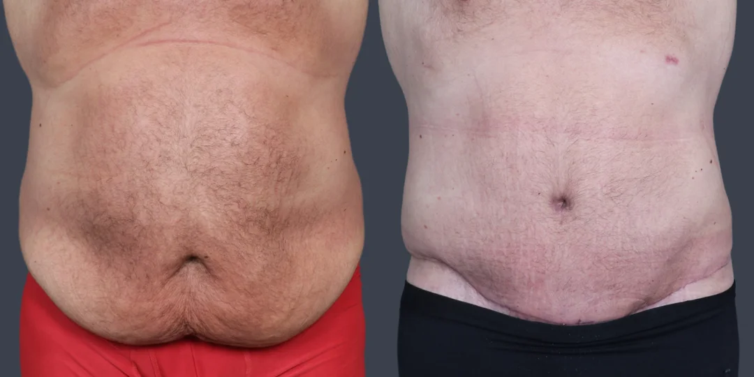 Tummy Tuck (Abdominoplasty) procedure image