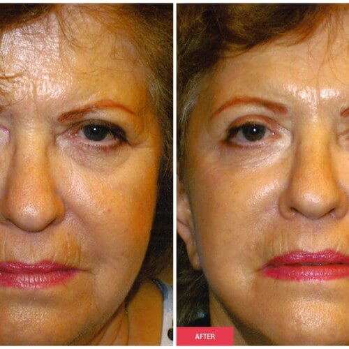 Facelift procedure image