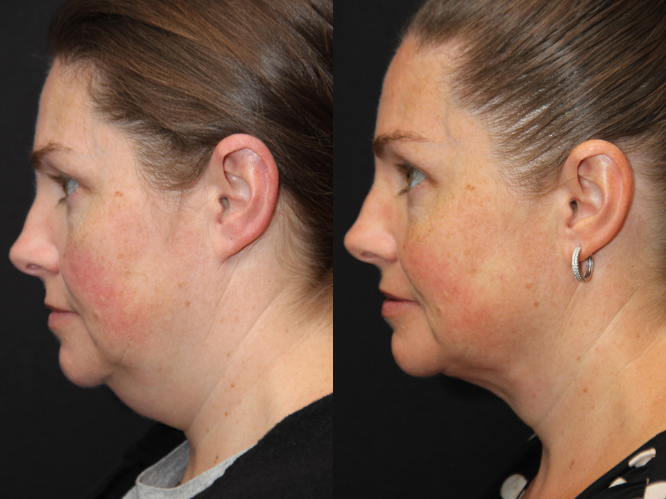 Neck Lift procedure image