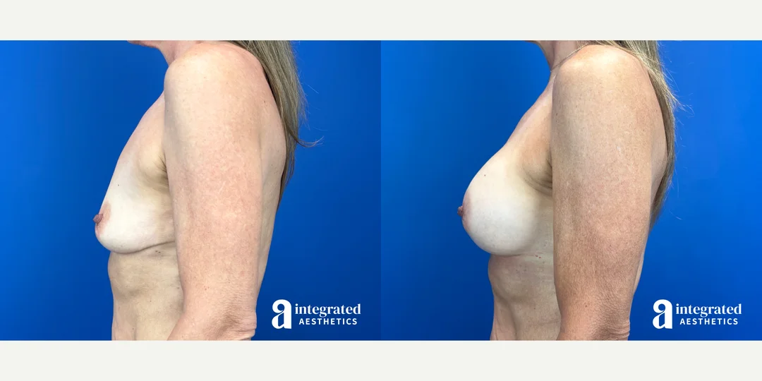 Breast Augmentation procedure image