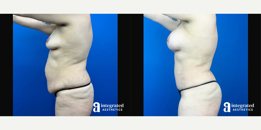 Liposuction procedure image