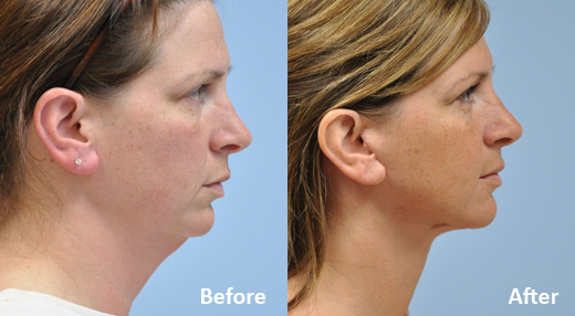 Rhinoplasty (Nose Job) procedure image