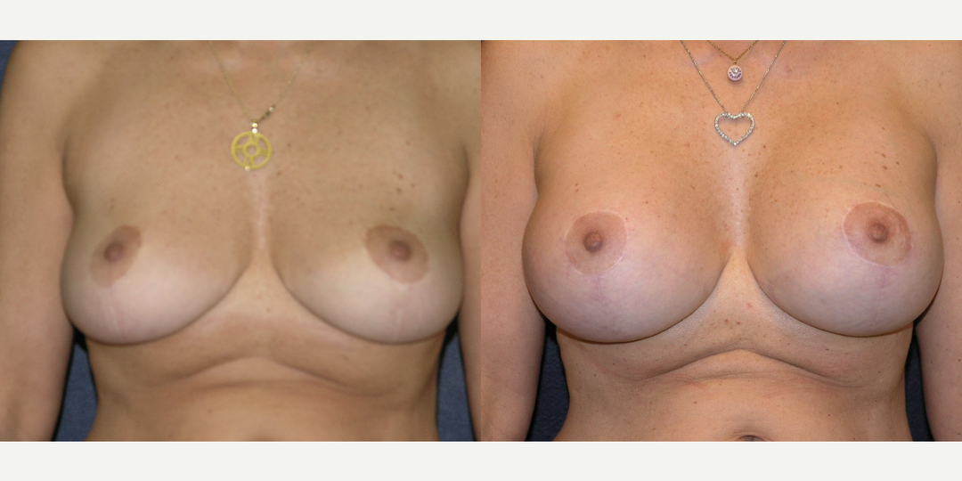 Breast Lift (Mastopexy) procedure image